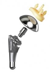 AltiVateâ„¢ Anatomic