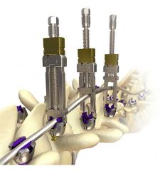 MESAÂ® 2 Deformity Spinal System Product