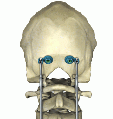 CASPIANÂ® Occipital Anchor Spinal System Product