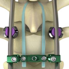 NILEÂ® Proximal Fixation Spinal System Product