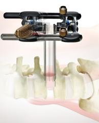 RAVINEÂ® Lateral Access System Product