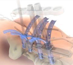 SERENGETIÂ® Complex Minimally Invasive Retractor System Product