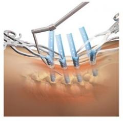SERENGETIÂ® Minimally Invasive Retractor System Product