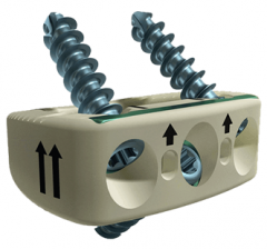 CHESAPEAKEÂ® Anterior-Lumbar Stabilization System Product