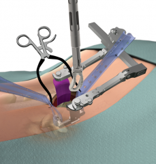TERRA NOVAÂ® Minimally Invasive Access System Product