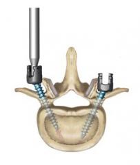 DENALIÂ® Degenerative Spinal System Product