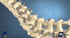 EVERESTÂ® Deformity Spinal System Product