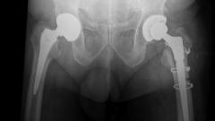 ExprtÂ® Revision Hip Product